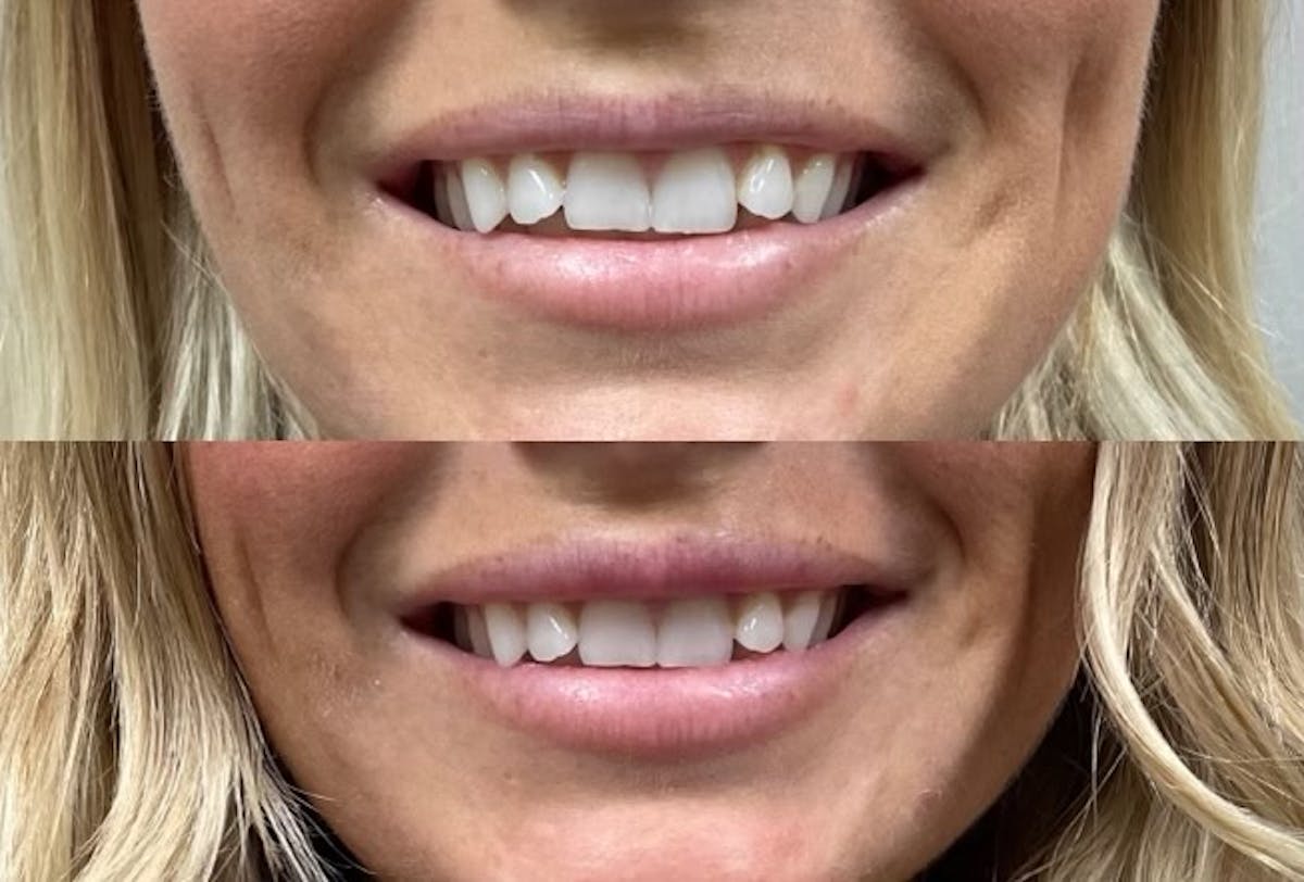 Lip Filler Before & After Gallery - Patient 307159 - Image 1