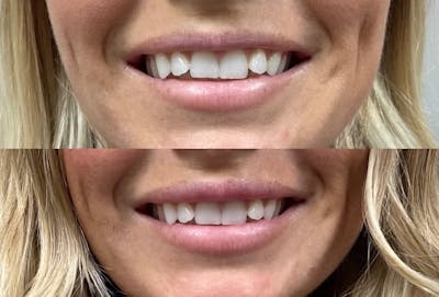 Lip Filler Before & After Gallery - Patient 307159 - Image 1
