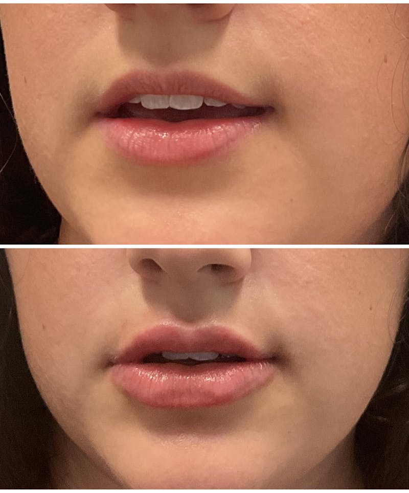 Lip Filler Before & After Gallery - Patient 328611 - Image 2