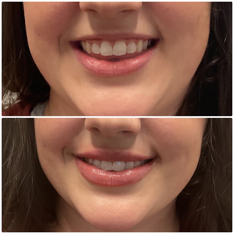 Lip Filler Before & After Gallery - Patient 328611 - Image 1