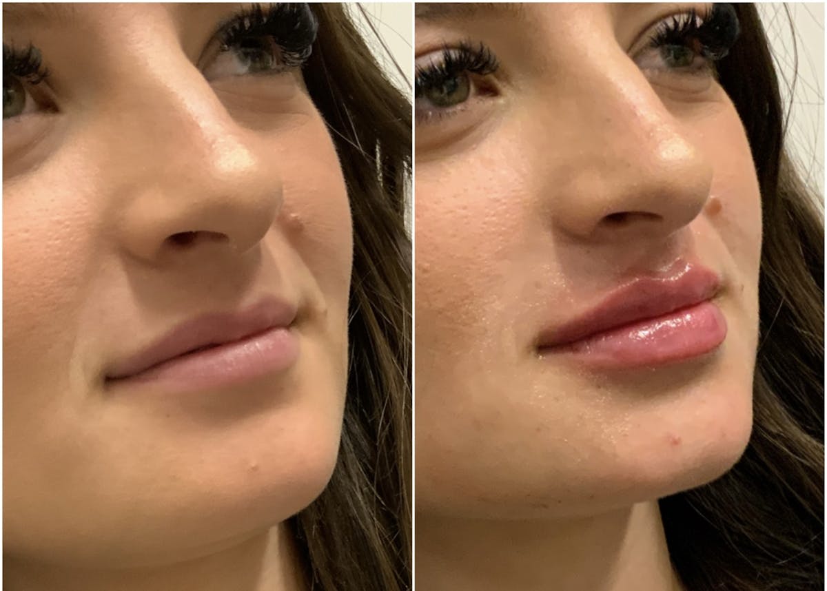 Lip Filler Before & After Gallery - Patient 231093 - Image 1