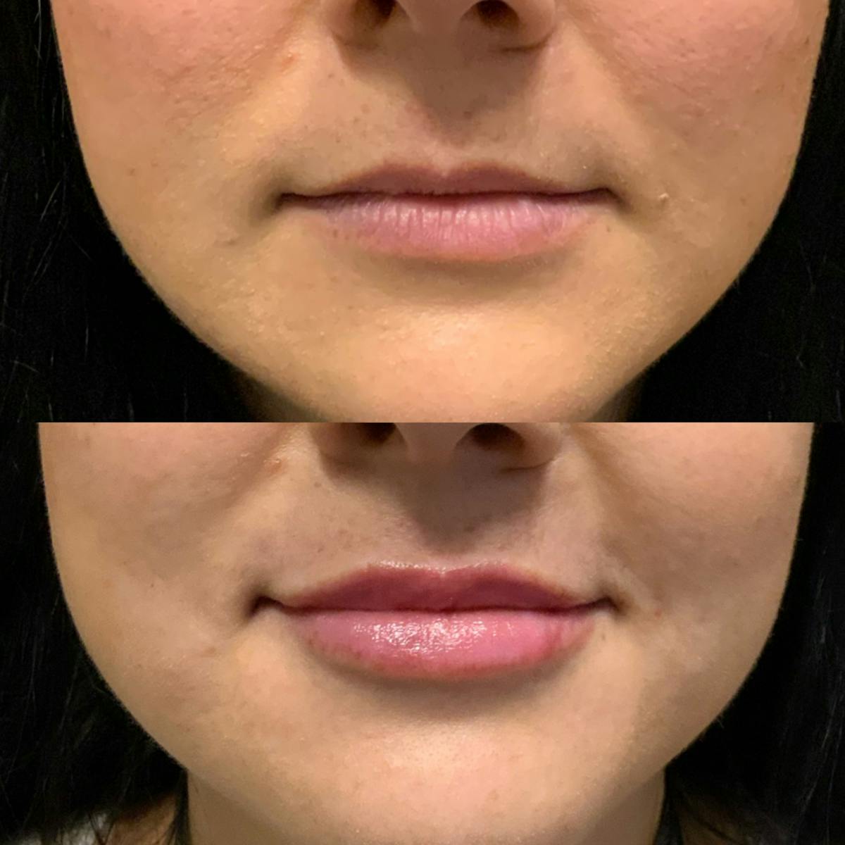 Lip Filler Before & After Gallery - Patient 576879 - Image 1