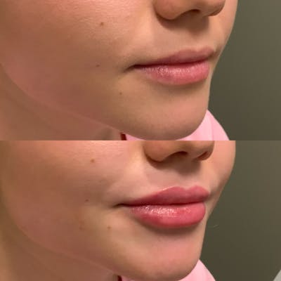 Lip Filler Before & After Gallery - Patient 162064 - Image 1