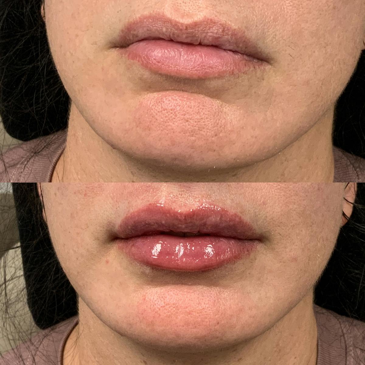 Lip Filler Before & After Gallery - Patient 325428 - Image 1