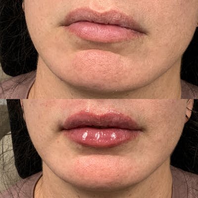 Lip Filler Before & After Gallery - Patient 325428 - Image 1