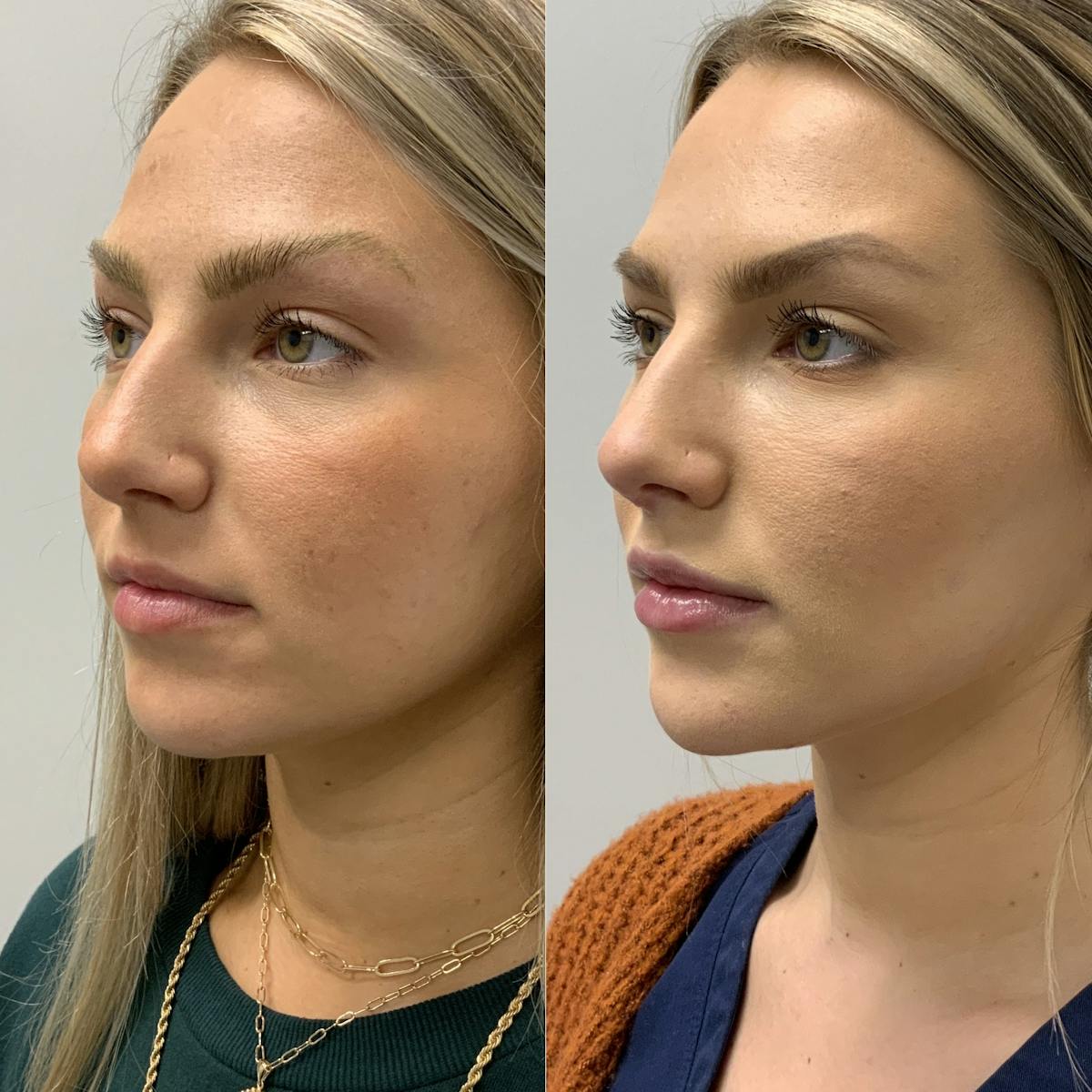 Dermal Filler Before & After Gallery - Patient 150910 - Image 1