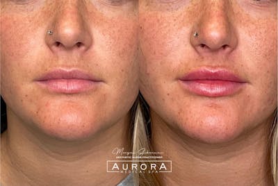 Dermal Filler Before & After Gallery - Patient 257686 - Image 2