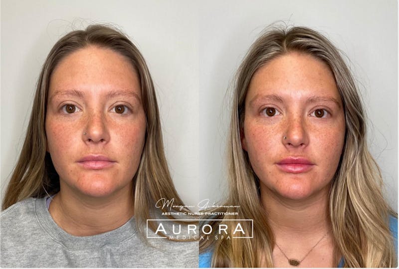Dermal Filler Before & After Gallery - Patient 257686 - Image 1