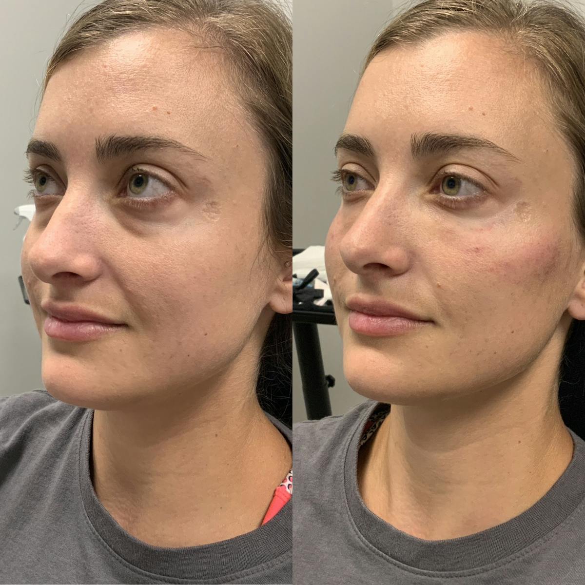 Dermal Filler Before & After Gallery - Patient 411891 - Image 1