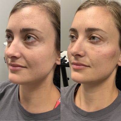 Dermal Filler Before & After Gallery - Patient 411891 - Image 1