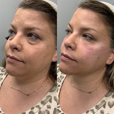 Dermal Filler Before & After Gallery - Patient 396522 - Image 2