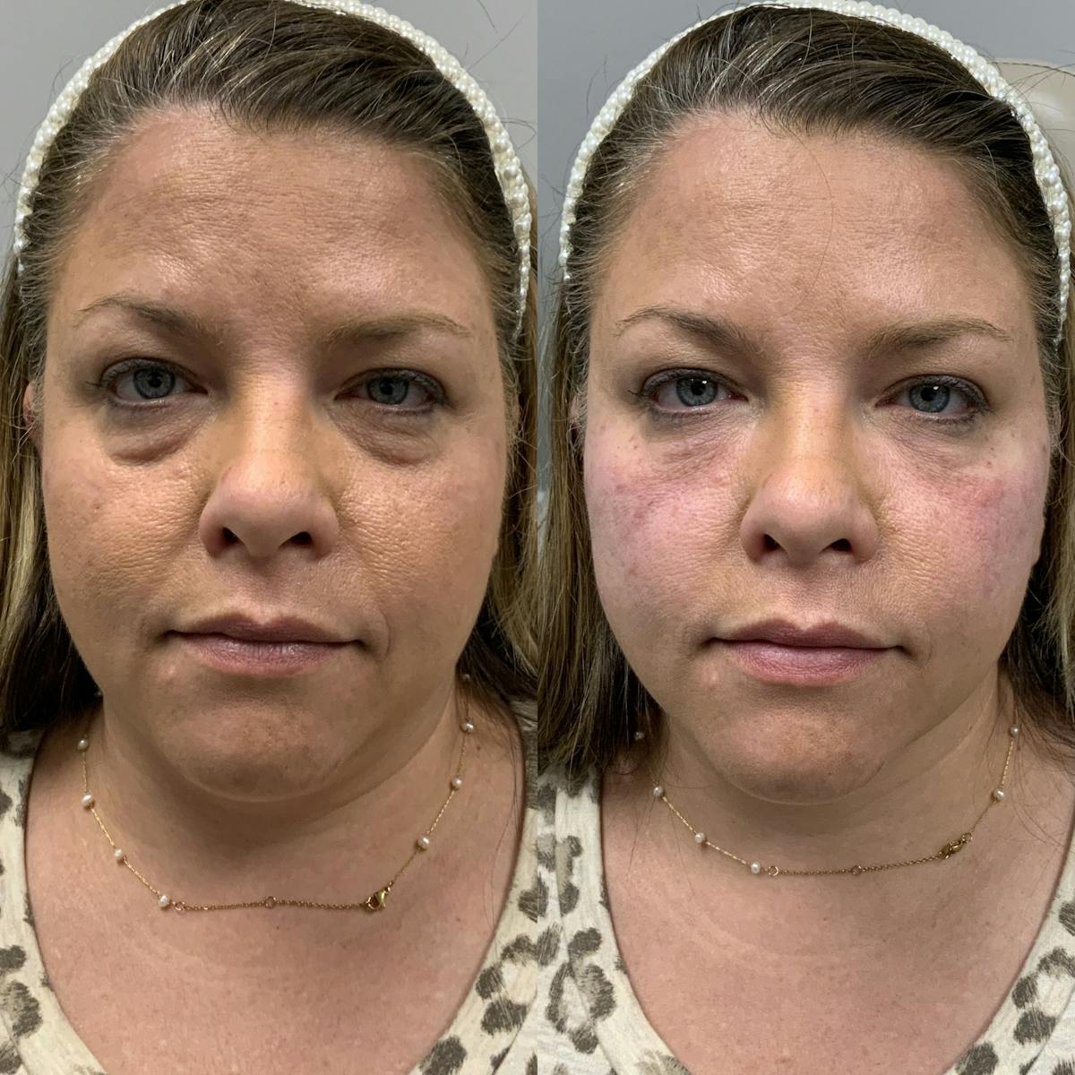 Dermal Filler Before & After Gallery - Patient 396522 - Image 1