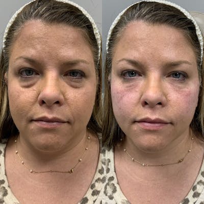 Dermal Filler Before & After Gallery - Patient 396522 - Image 1