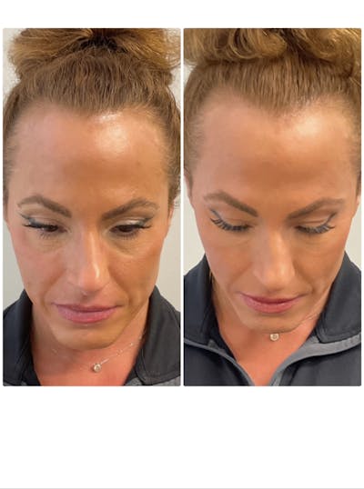 Dermal Filler Before & After Gallery - Patient 171242 - Image 1