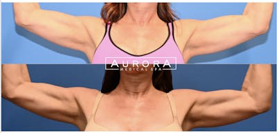 Emsculpt Neo Before & After Gallery - Patient 275454 - Image 1