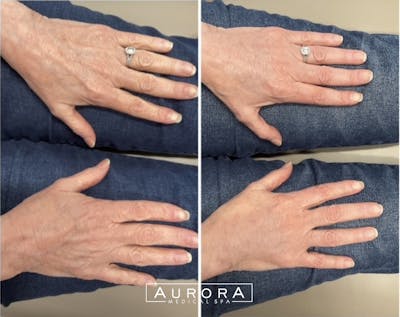 Hand Rejuvenation Before & After Gallery - Patient 355028 - Image 1
