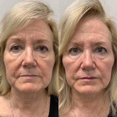 BOTOX Before & After Gallery - Patient 499992 - Image 1