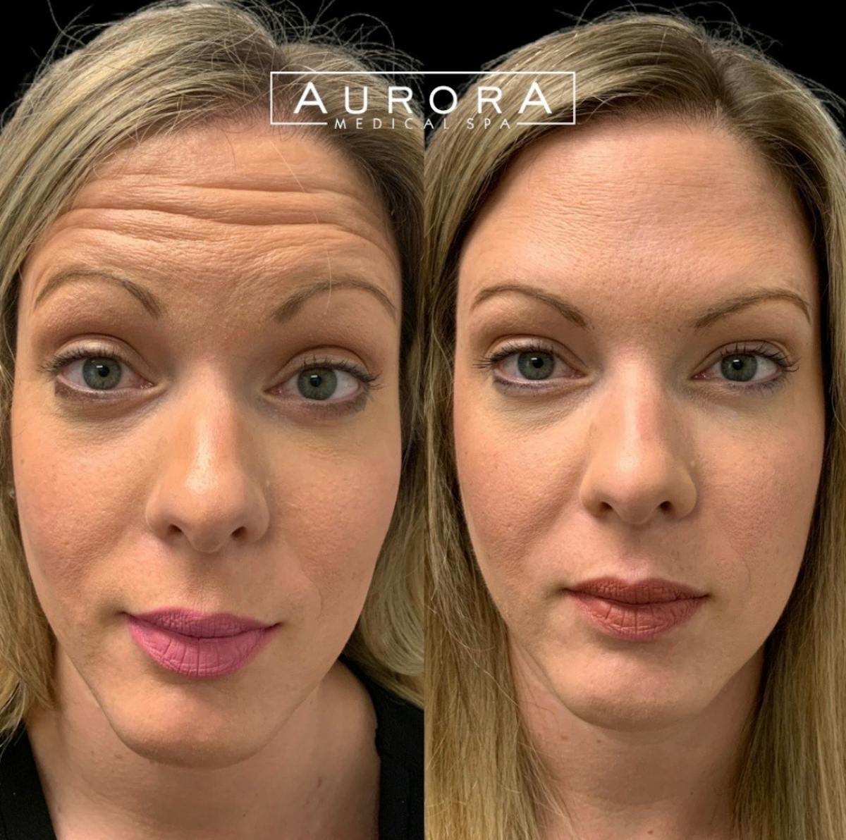 BOTOX Before & After Gallery - Patient 294261 - Image 1