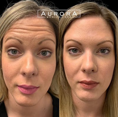 BOTOX Before & After Gallery - Patient 294261 - Image 1