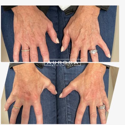 Hand Rejuvenation Before & After Gallery - Patient 205926 - Image 1