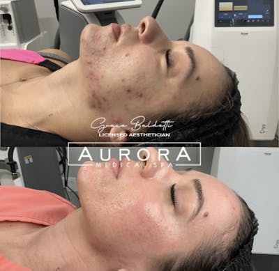 LaseMD Before & After Gallery - Patient 170779 - Image 1