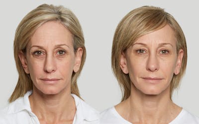Sculptra Before & After Gallery - Patient 379536 - Image 1
