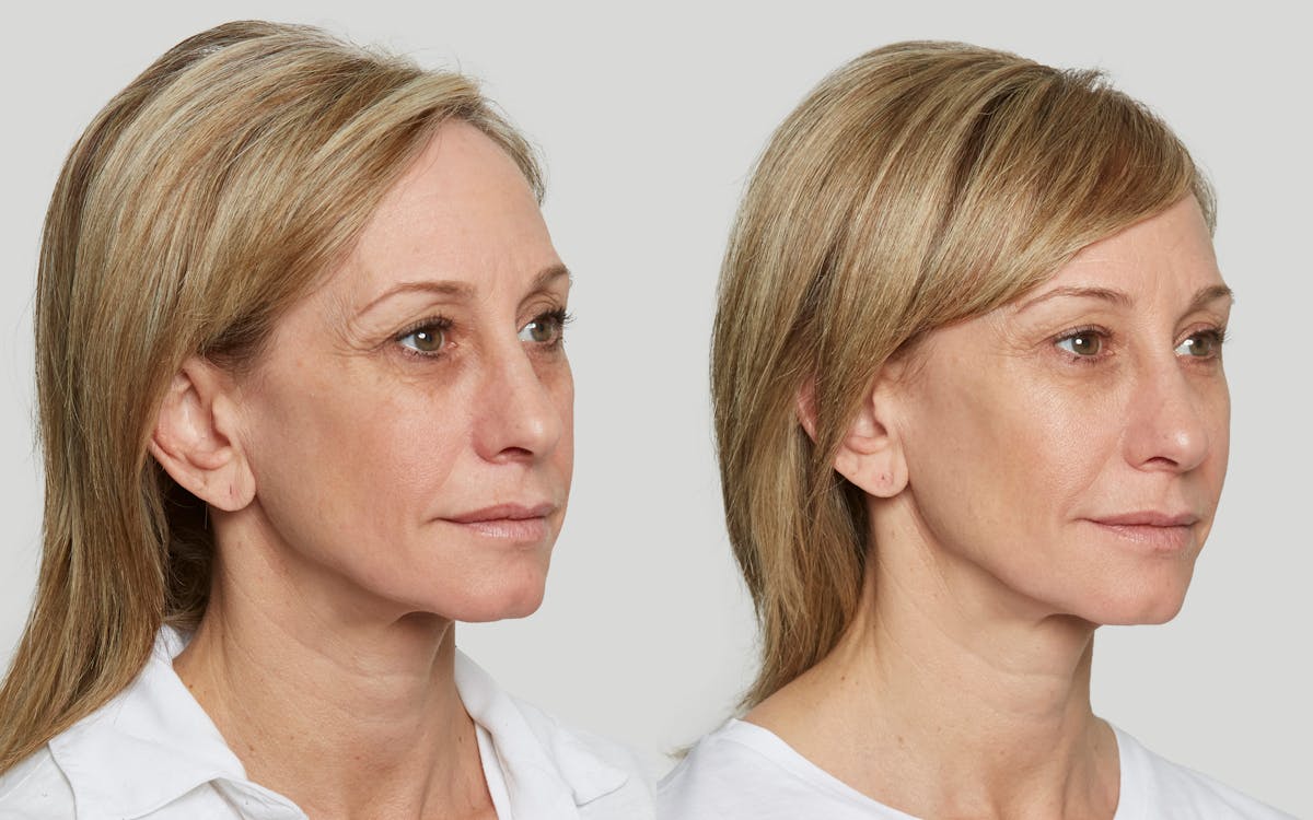 Sculptra Before & After Gallery - Patient 379536 - Image 2