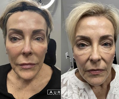Diamond Glow Before & After Gallery - Patient 367405 - Image 1