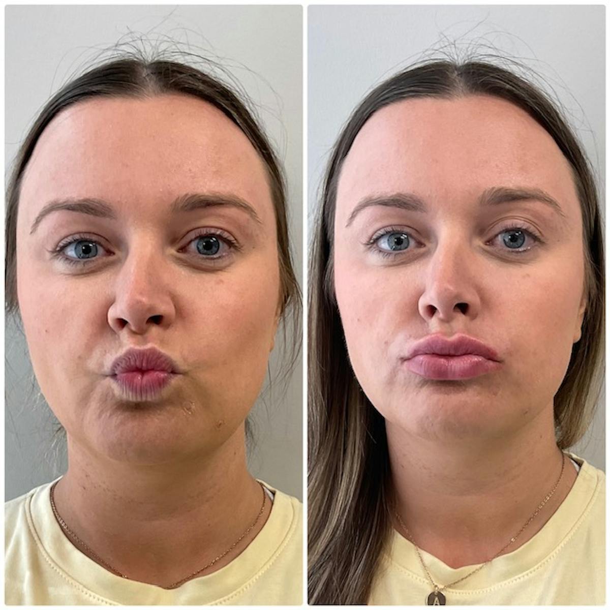 Lip Filler Before & After Gallery - Patient 325169 - Image 2