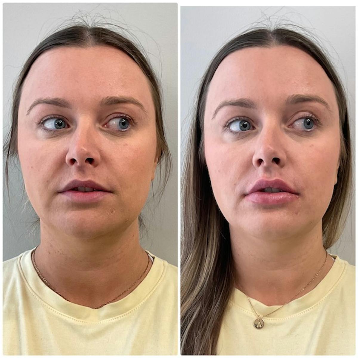 Lip Filler Before & After Gallery - Patient 325169 - Image 1