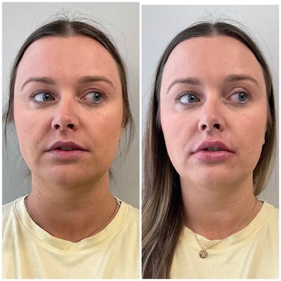 Lip Filler Before & After Gallery - Patient 325169 - Image 1