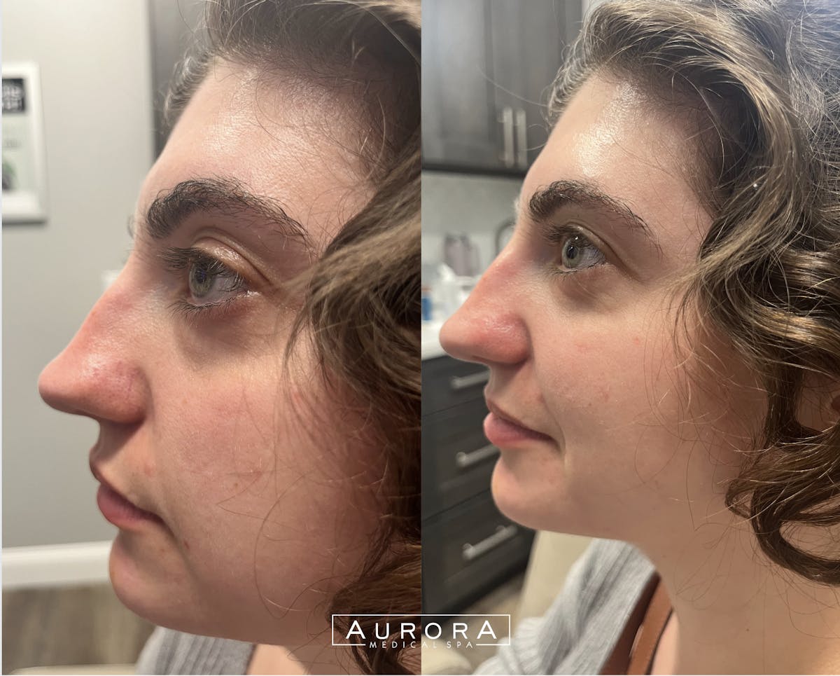 Facial Balancing Before & After Gallery - Patient 319159 - Image 1