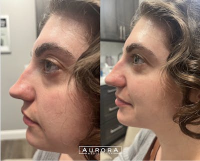 Facial Balancing Before & After Gallery - Patient 319159 - Image 1