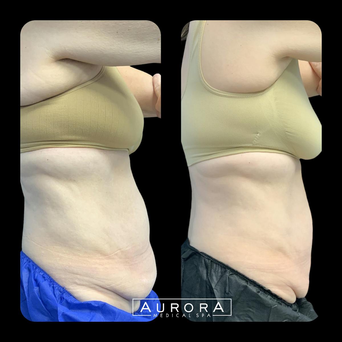Coolsculpting Elite Before & After Gallery - Patient 601010 - Image 1