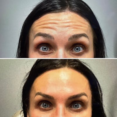 DAXXIFY Before & After Gallery - Patient 519173 - Image 1