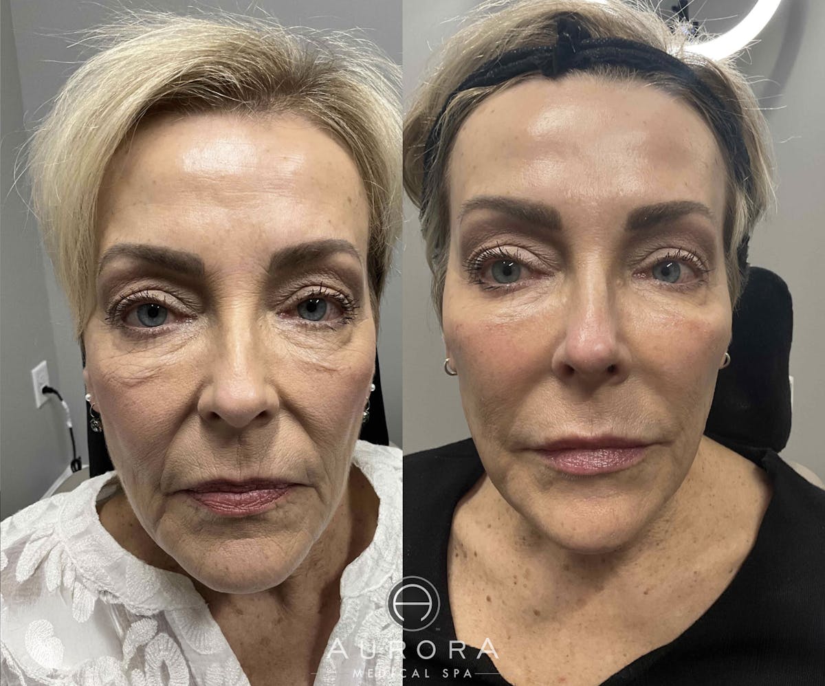 Dermal Filler Before & After Gallery - Patient 123311 - Image 1