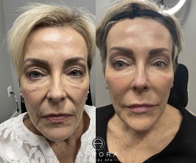 Dermal Filler Before & After Gallery - Patient 123311 - Image 1