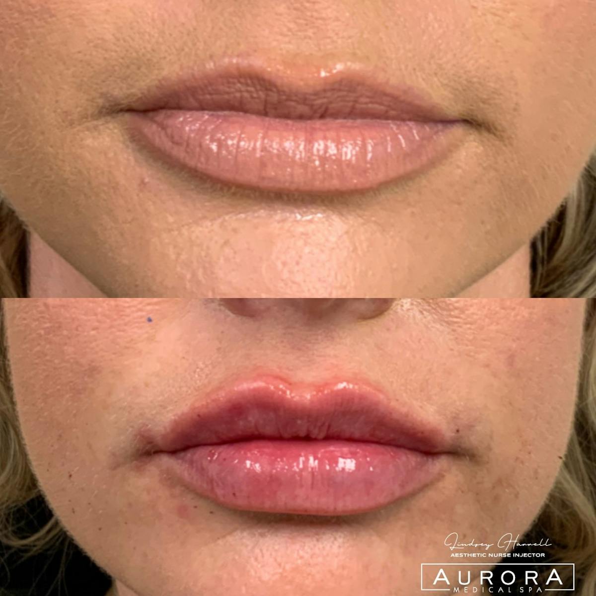 Lip Filler Before & After Gallery - Patient 383301 - Image 1