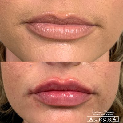 Lip Filler Before & After Gallery - Patient 383301 - Image 1