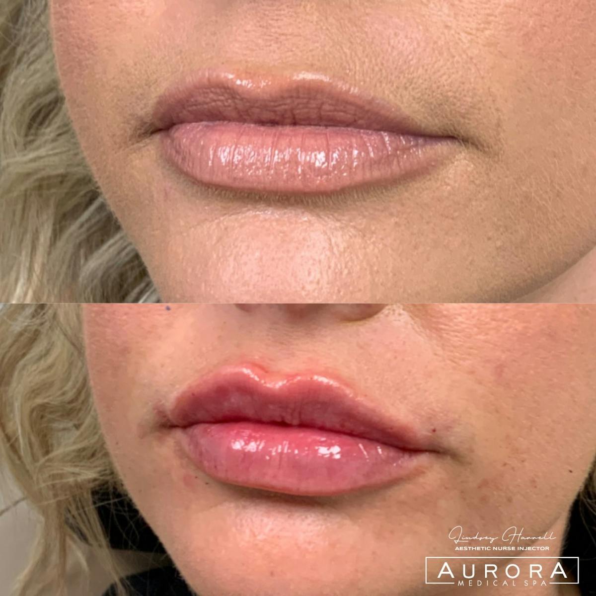 Lip Filler Before & After Gallery - Patient 383301 - Image 2