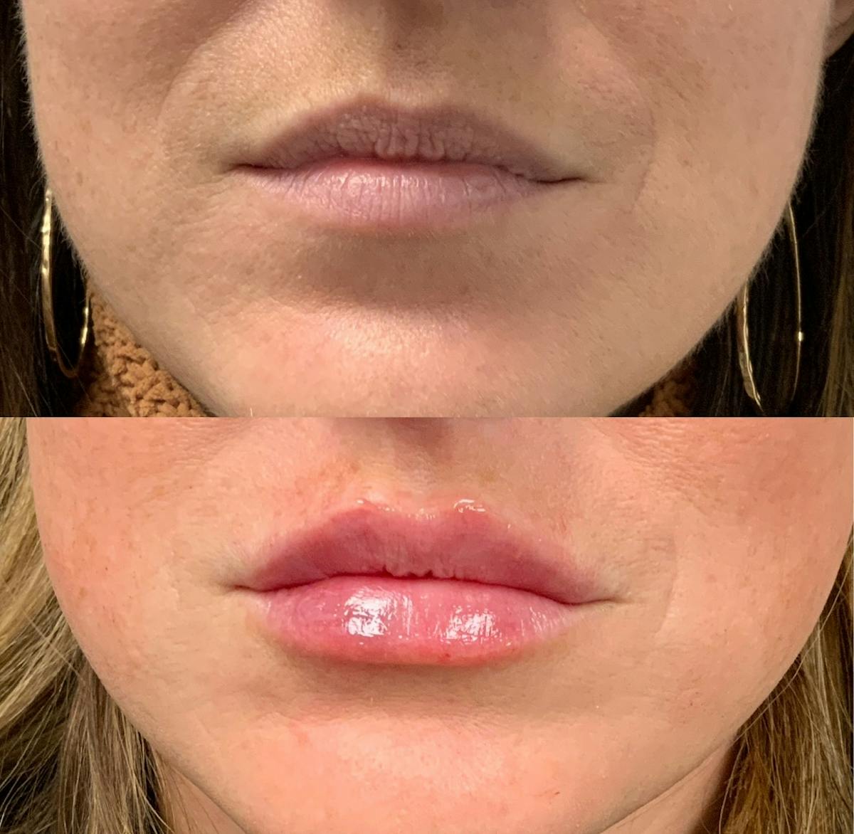 Lip Filler Before & After Gallery - Patient 165114 - Image 1