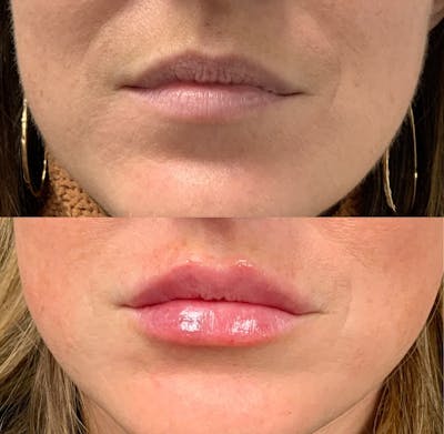 Lip Filler Before & After Gallery - Patient 165114 - Image 1