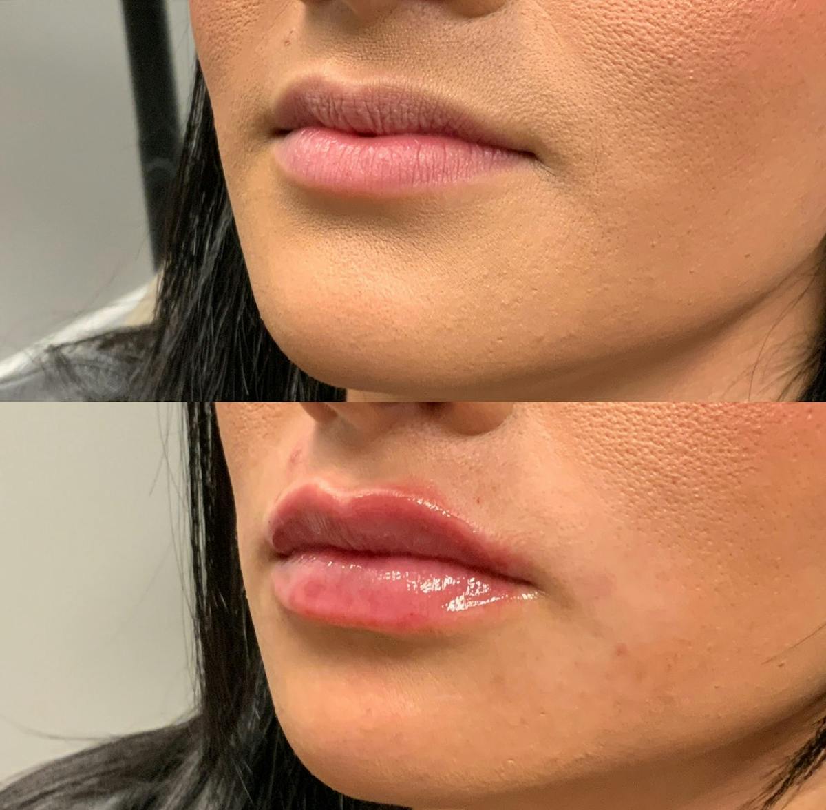 Lip Filler Before & After Gallery - Patient 228807 - Image 1