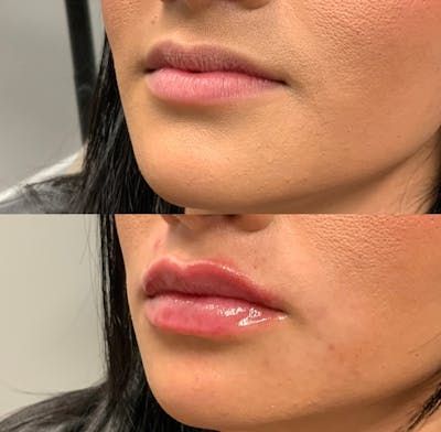Lip Filler Before & After Gallery - Patient 228807 - Image 1