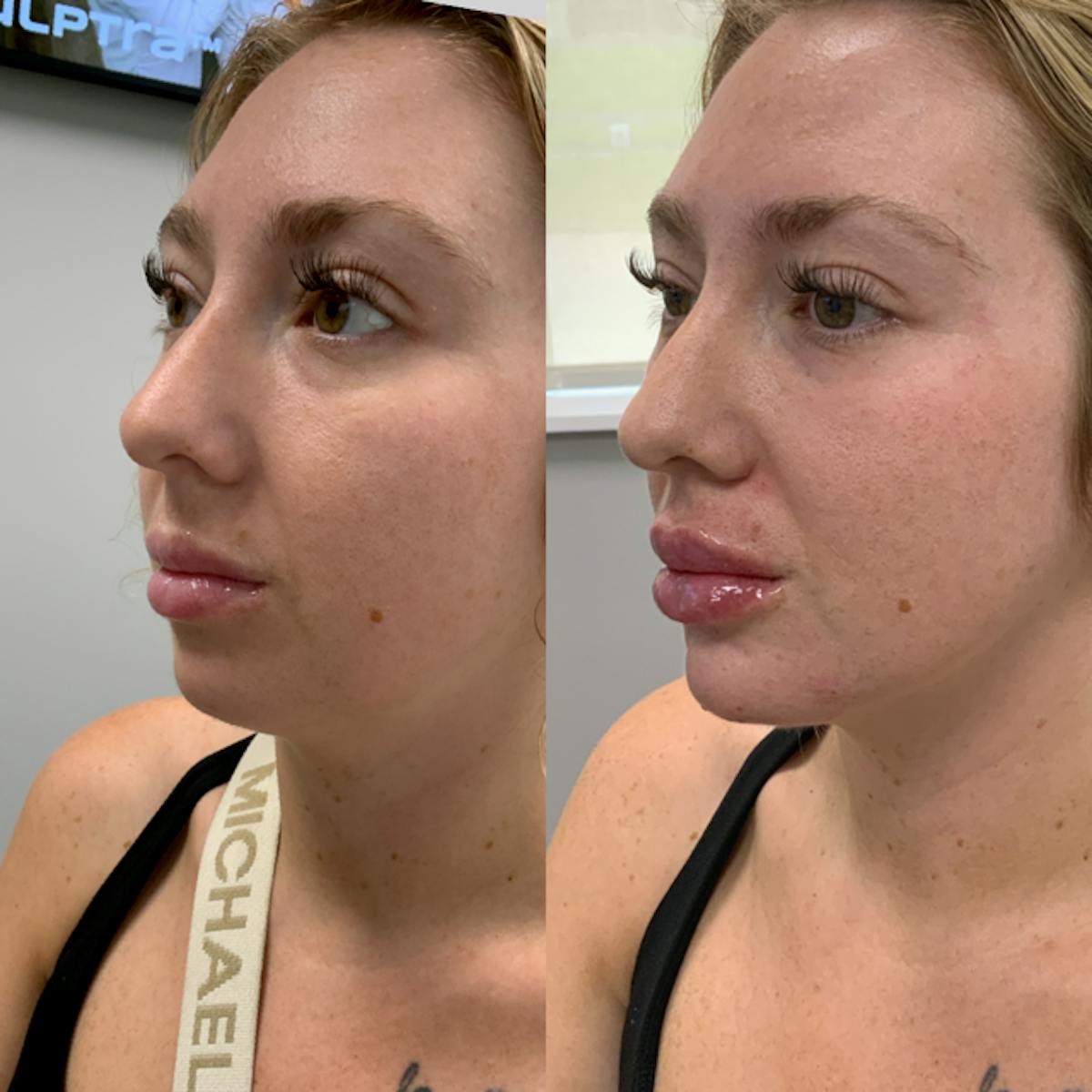 Lip Filler Before & After Gallery - Patient 240080 - Image 1