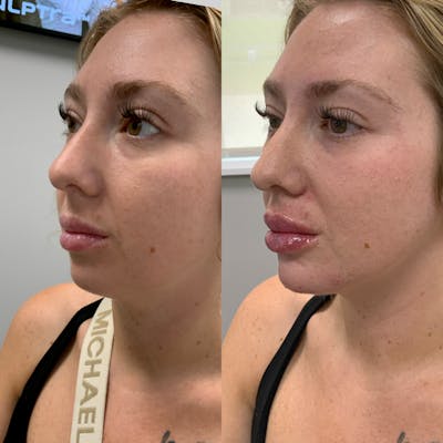 Lip Filler Before & After Gallery - Patient 240080 - Image 1