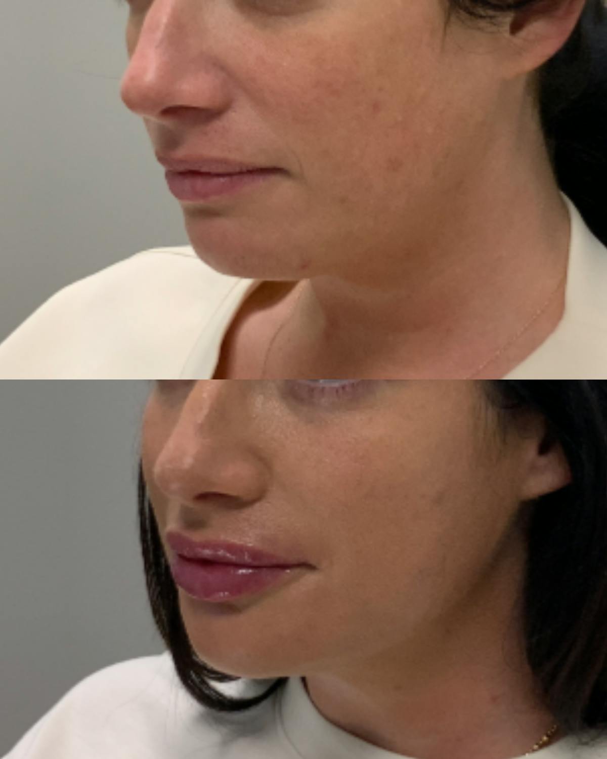Dermal Filler Before & After Gallery - Patient 518590 - Image 3