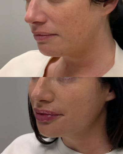Lip Filler Before & After Gallery - Patient 375529 - Image 1