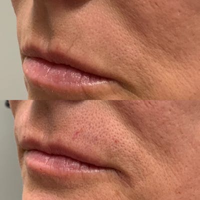 Lip Filler Before & After Gallery - Patient 373111 - Image 1