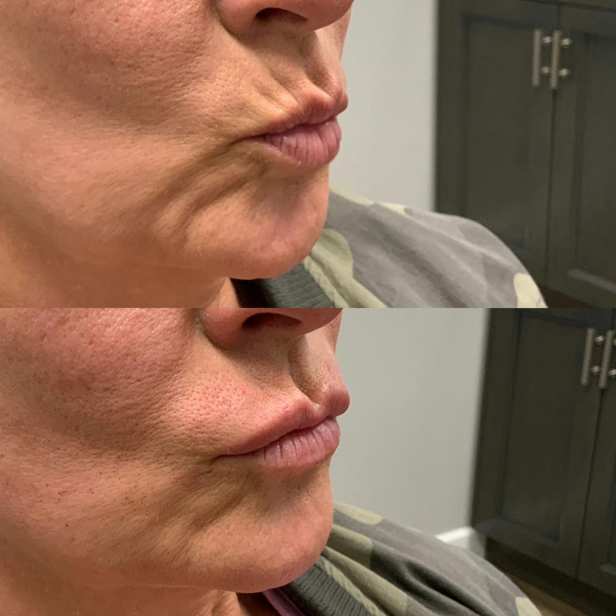 Lip Filler Before & After Gallery - Patient 373111 - Image 2